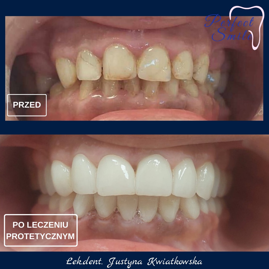 Efekt przed i po leczeniu protetycznym w Perfect Smile Konin
